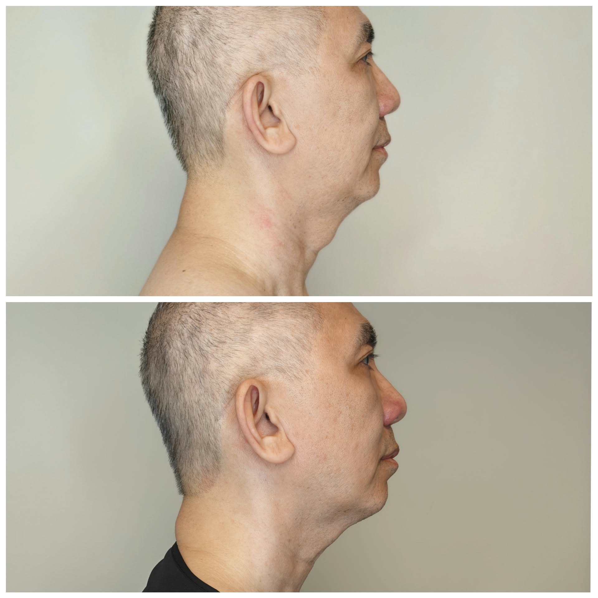 Dr. Han Nguyens egna resultat före och efter Endolaser. Före överst, efter underst.